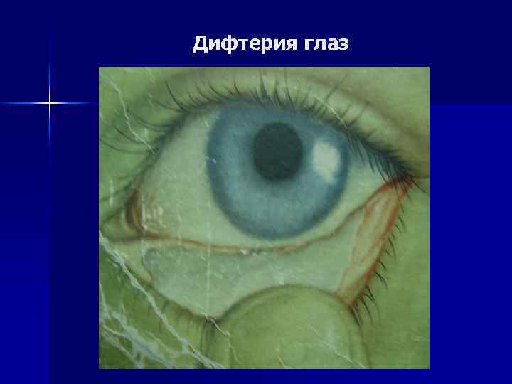 Дифтерия глаз 