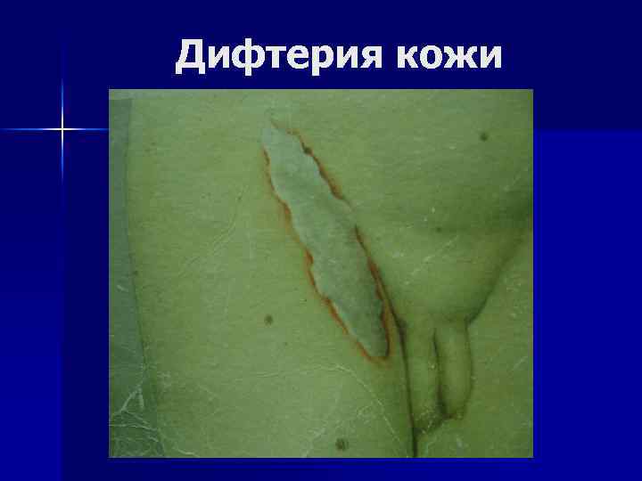 Дифтерия кожи 
