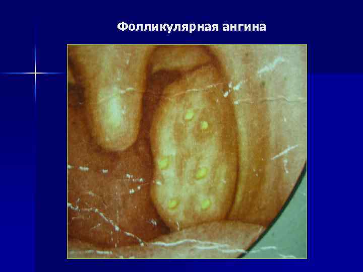 Фолликулярная ангина 
