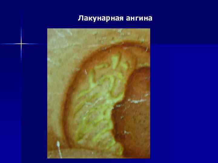 Лакунарная ангина 