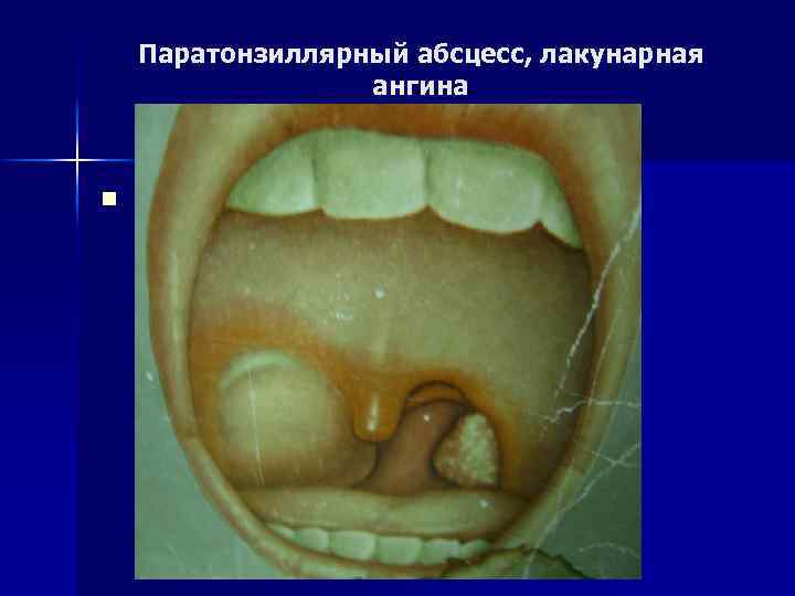 Паратонзиллярный абсцесс, лакунарная ангина n 