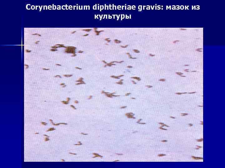 Corynebacterium diphtheriae gravis: мазок из культуры 