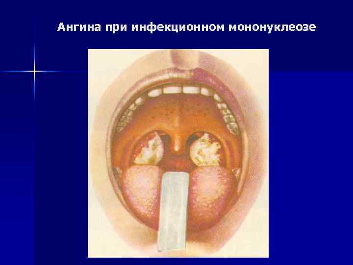 Ангина при инфекционном мононуклеозе 