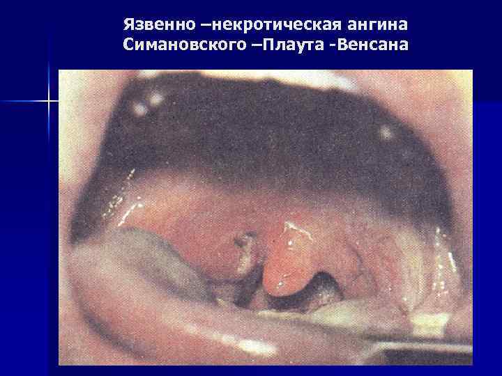 Язвенно –некротическая ангина Симановского –Плаута -Венсана 