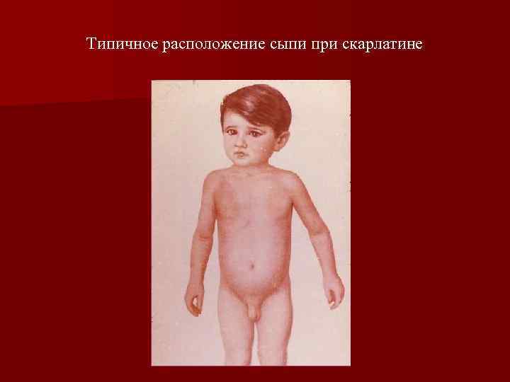 Типичное расположение сыпи при скарлатине 