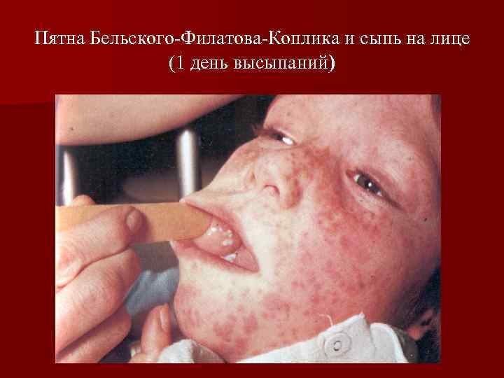 Пятна Бельского-Филатова-Коплика и сыпь на лице (1 день высыпаний) 