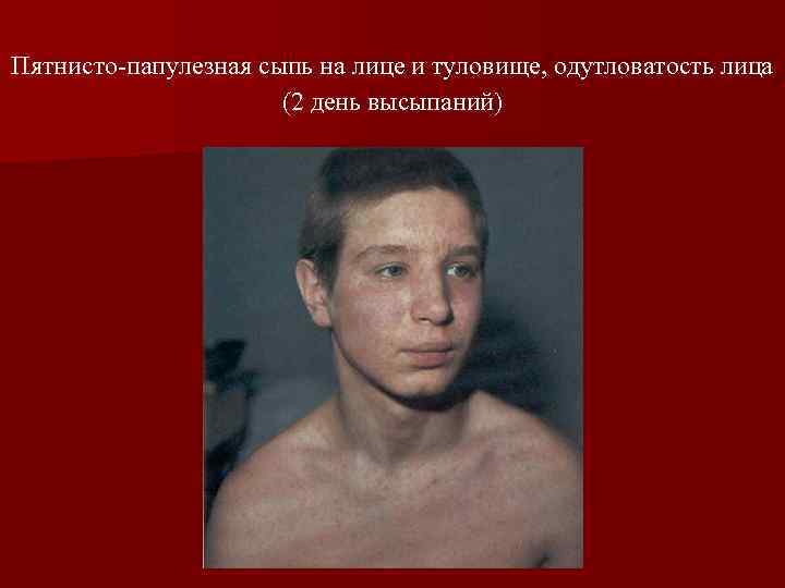 Пятнисто-папулезная сыпь на лице и туловище, одутловатость лица (2 день высыпаний) 