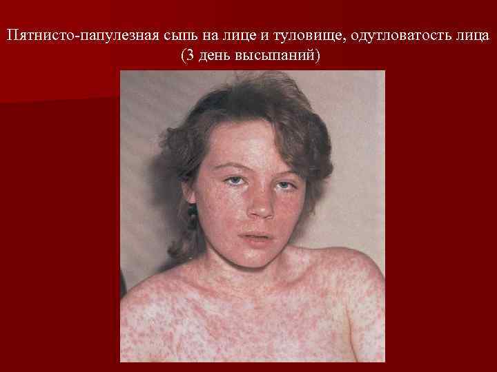 Пятнисто-папулезная сыпь на лице и туловище, одутловатость лица (3 день высыпаний) 
