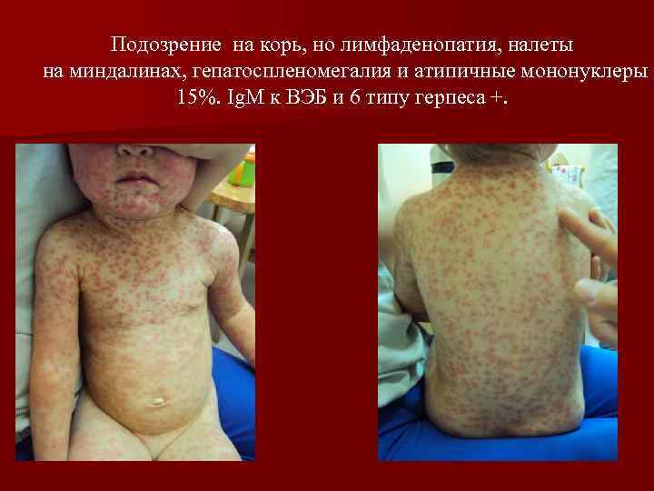 Подозрение на корь, но лимфаденопатия, налеты на миндалинах, гепатоспленомегалия и атипичные мононуклеры 15%. Ig.