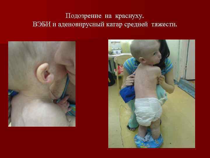 Подозрение на краснуху. ВЭБИ и аденовирусный катар средней тяжести. 