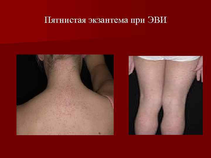 Пятнистая экзантема при ЭВИ 