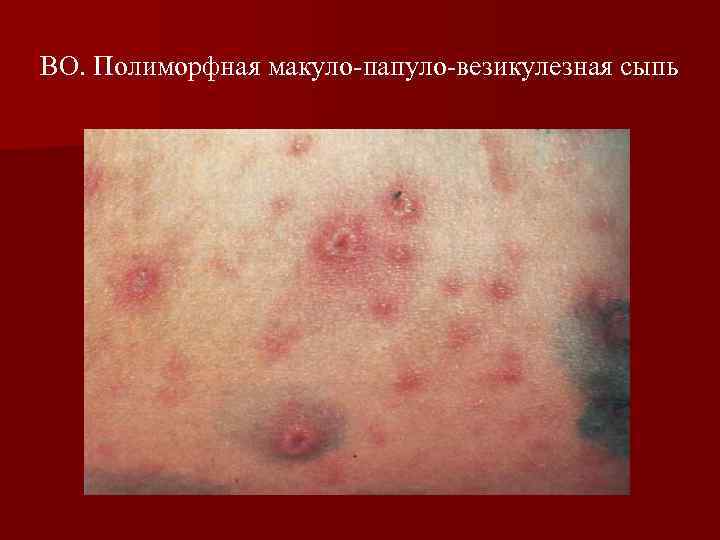 ВО. Полиморфная макуло-папуло-везикулезная сыпь 