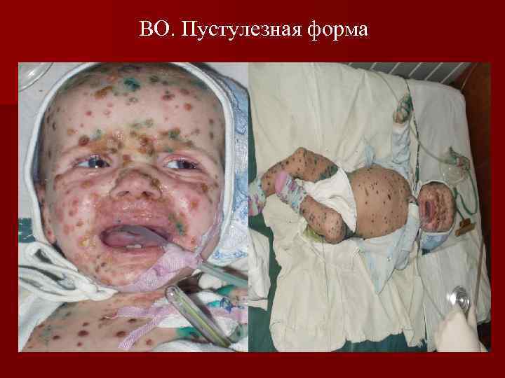 ВО. Пустулезная форма 