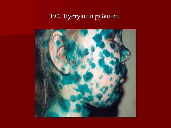 ВО. Пустулы и рубчики. 