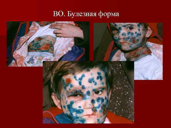 ВО. Булезная форма 