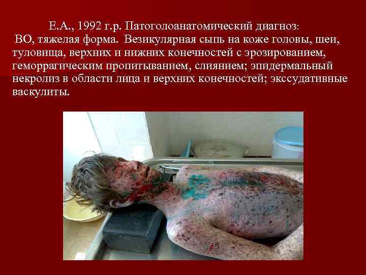Е. А. , 1992 г. р. Патоголоанатомический диагноз: ВО, тяжелая форма. Везикулярная сыпь на