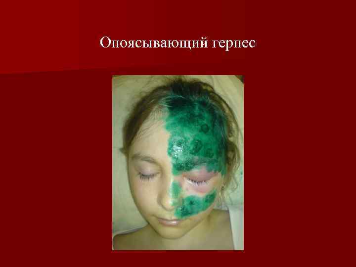 Опоясывающий герпес 