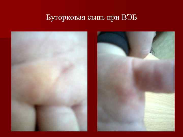 Бугорковая сыпь при ВЭБ 