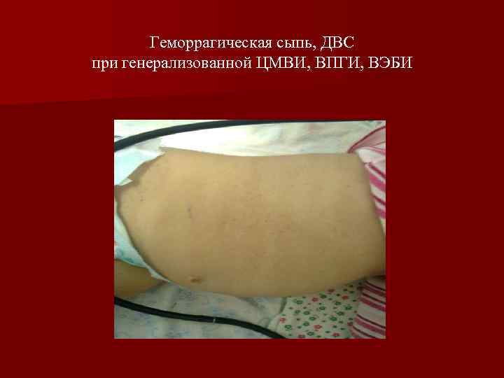 Геморрагическая сыпь, ДВС при генерализованной ЦМВИ, ВПГИ, ВЭБИ 