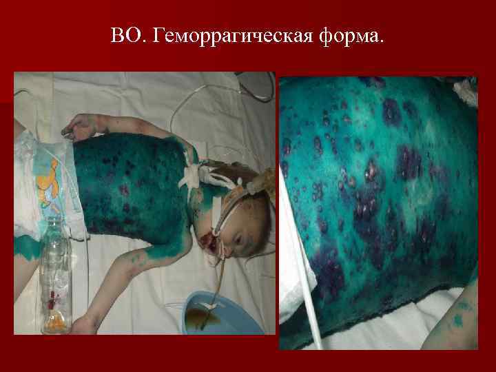 ВО. Геморрагическая форма. 