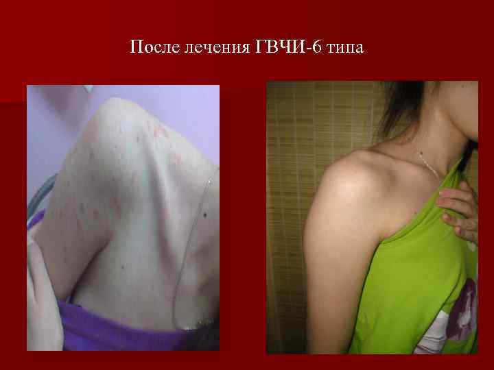 После лечения ГВЧИ-6 типа 