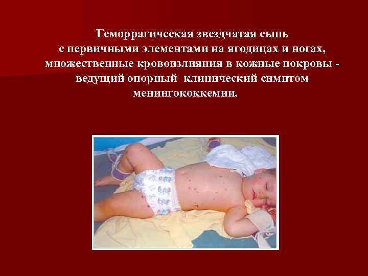 Геморрагическая звездчатая сыпь с первичными элементами на ягодицах и ногах, множественные кровоизлияния в кожные