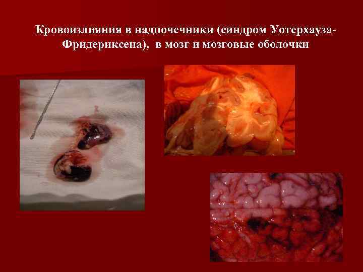 Кровоизлияния в надпочечники (синдром Уотерхауза. Фридериксена), в мозг и мозговые оболочки 