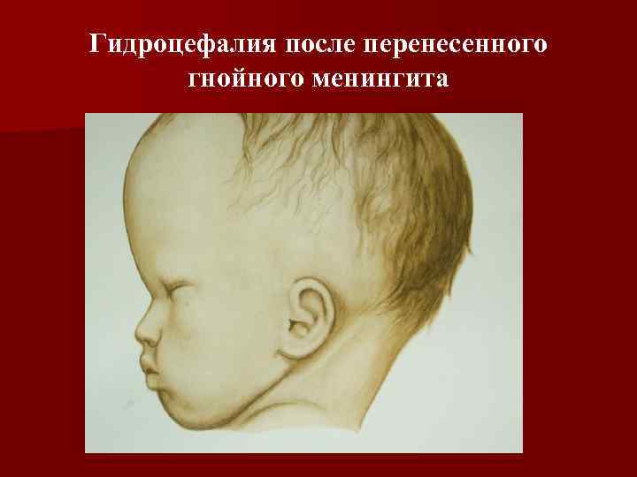 Гидроцефалия после перенесенного гнойного менингита 