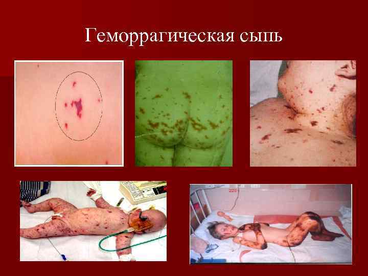 Геморрагическая сыпь 