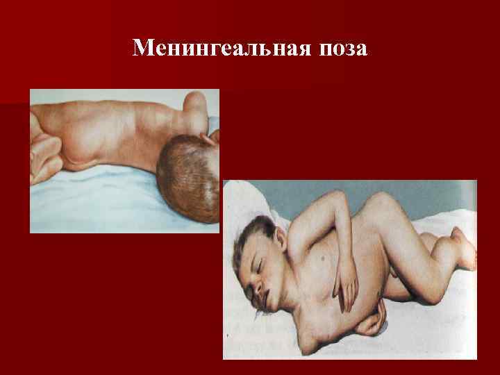 Менингеальная поза 