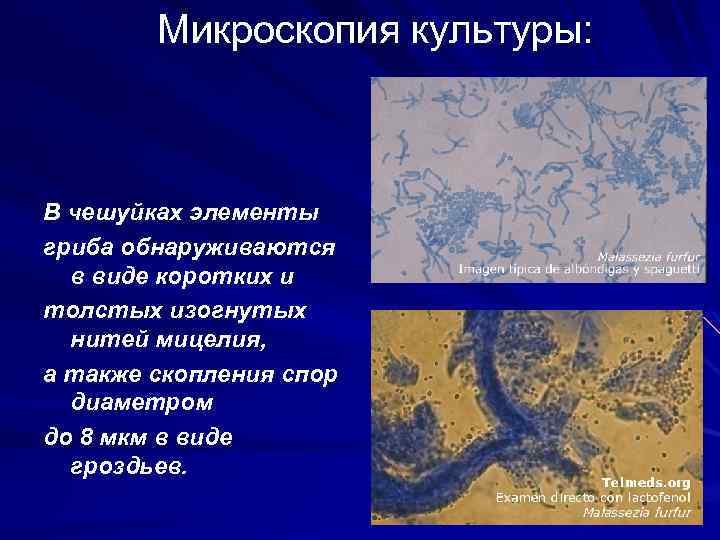 Микроскопия культуры: В чешуйках элементы гриба обнаруживаются в виде коротких и толстых изогнутых нитей