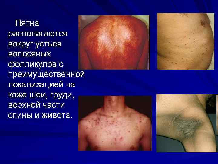 Пятна располагаются вокруг устьев волосяных фолликулов с преимущественной локализацией на коже шеи, груди, верхней