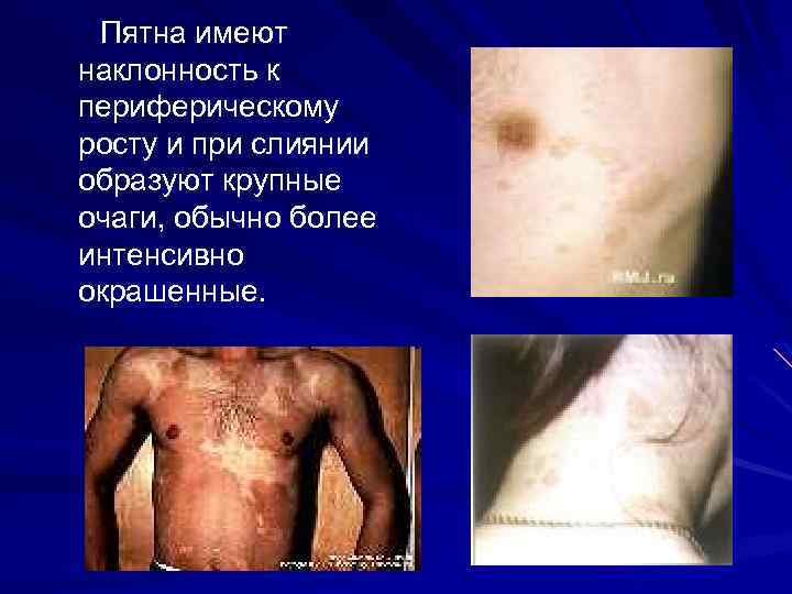 Пятна имеют наклонность к периферическому росту и при слиянии образуют крупные очаги, обычно более