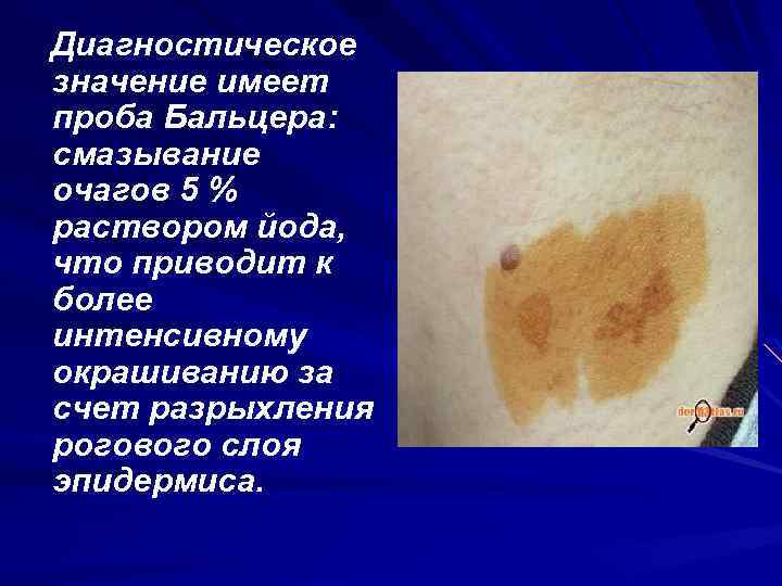 Диагностическое значение имеет проба Бальцера: смазывание очагов 5 % раствором йода, что приводит к