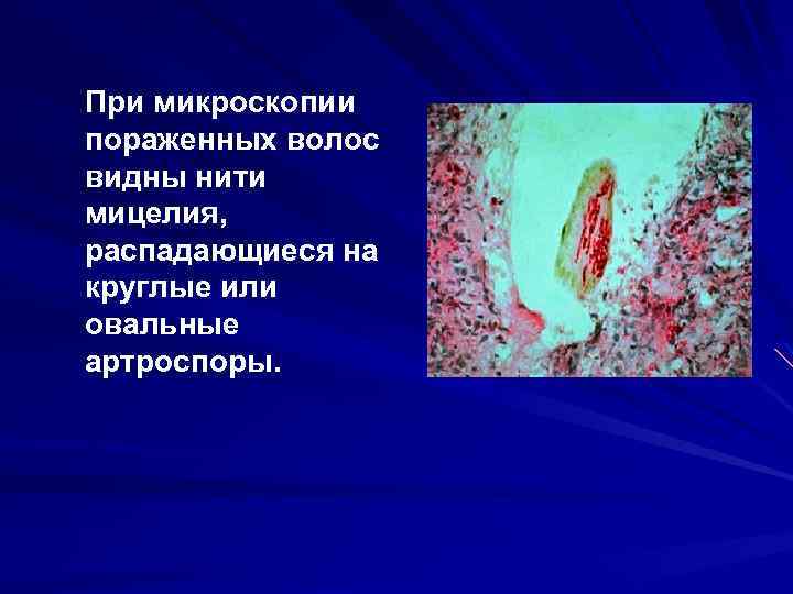 При микроскопии пораженных волос видны нити мицелия, распадающиеся на круглые или овальные артроспоры. 