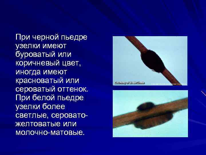 При черной пьедре узелки имеют буроватый или коричневый цвет, иногда имеют красноватый или сероватый