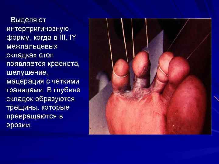 Выделяют интертригинозную форму, когда в III, IY межпальцевых складках стоп появляется краснота, шелушение, мацерация