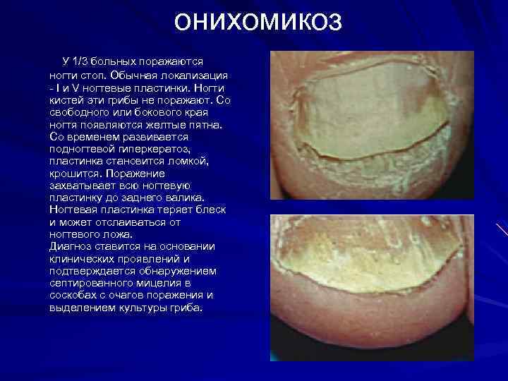 онихомикоз У 1/3 больных поражаются ногти стоп. Обычная локализация - I и V ногтевые