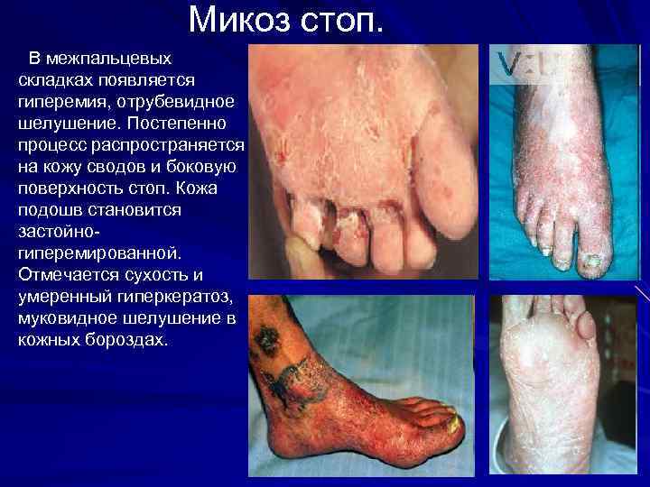 Микоз стоп. В межпальцевых складках появляется гиперемия, отрубевидное шелушение. Постепенно процесс распространяется на кожу