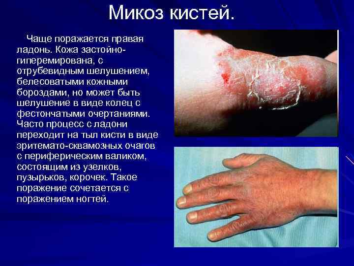 Микоз кистей. Чаще поражается правая ладонь. Кожа застойногиперемирована, с отрубевидным шелушением, белесоватыми кожными бороздами,
