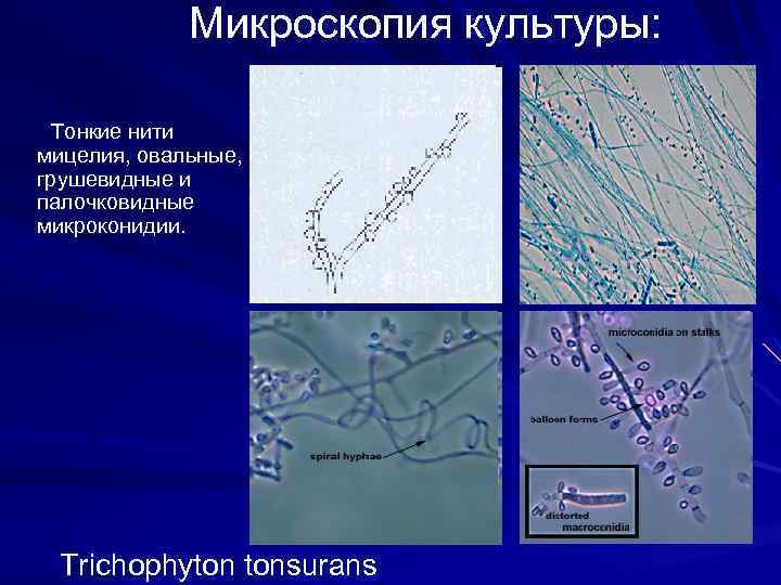 Микроскопия культуры: Тонкие нити мицелия, овальные, грушевидные и палочковидные микроконидии. Trichophyton tonsurans 