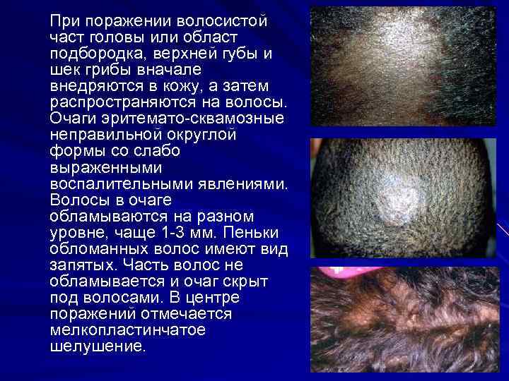 При поражении волосистой част головы или област подбородка, верхней губы и шек грибы вначале
