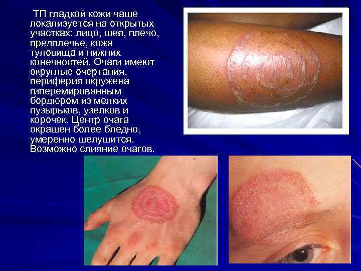 ТП гладкой кожи чаще локализуется на открытых участках: лицо, шея, плечо, предплечье, кожа туловища
