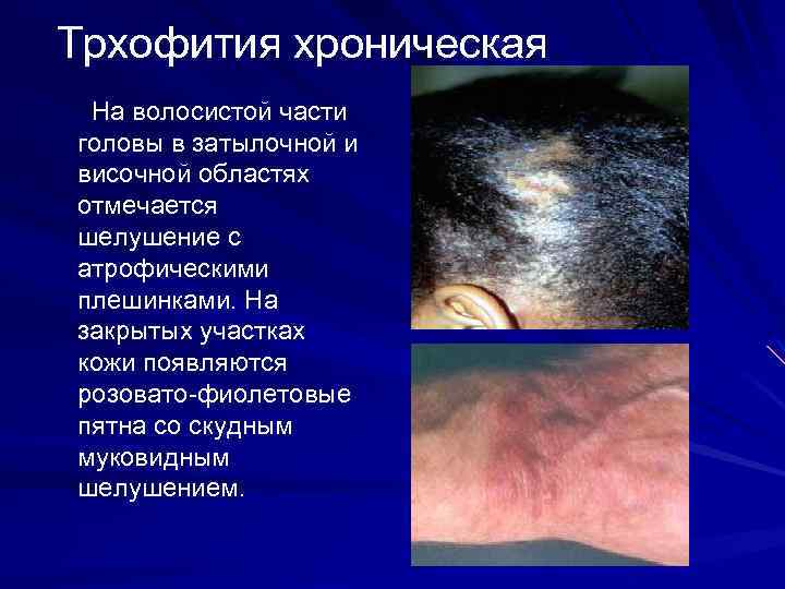 Трхофития хроническая На волосистой части головы в затылочной и височной областях отмечается шелушение с