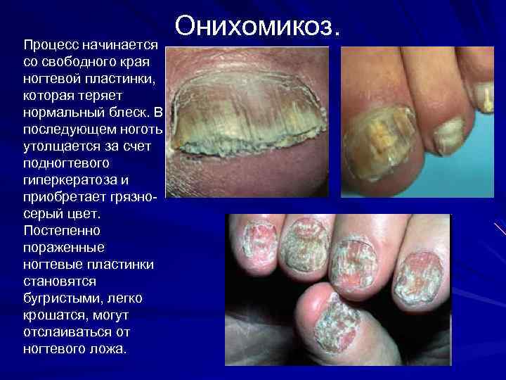Процесс начинается со свободного края ногтевой пластинки, которая теряет нормальный блеск. В последующем ноготь