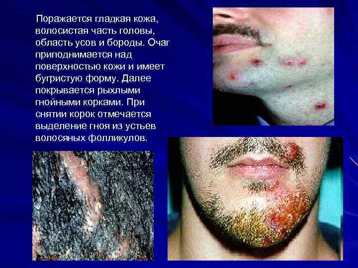Поражается гладкая кожа, волосистая часть головы, область усов и бороды. Очаг приподнимается над поверхностью