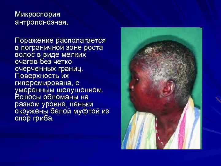 Микроспория антропонозная. Поражение располагается в пограничной зоне роста волос в виде мелких очагов без
