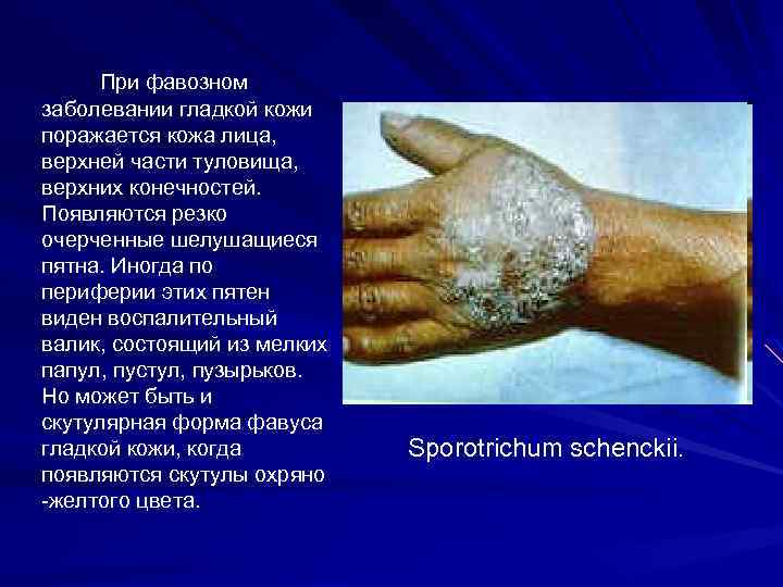 При фавозном заболевании гладкой кожи поражается кожа лица, верхней части туловища, верхних конечностей. Появляются