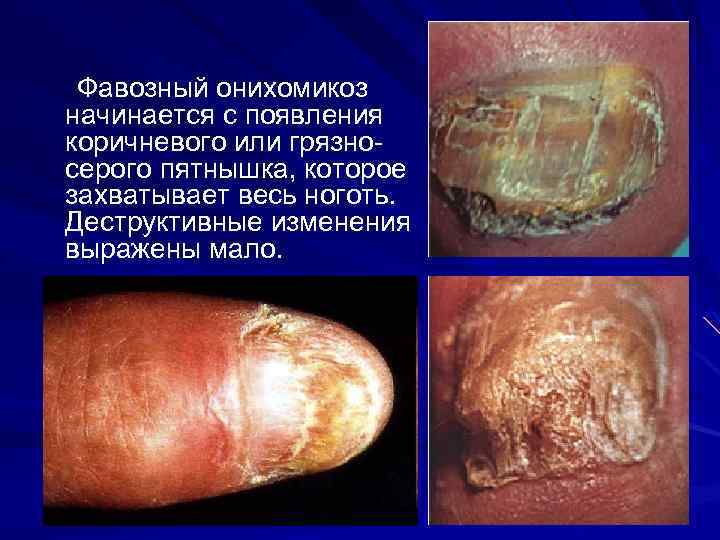 Фавозный онихомикоз начинается с появления коричневого или грязносерого пятнышка, которое захватывает весь ноготь. Деструктивные