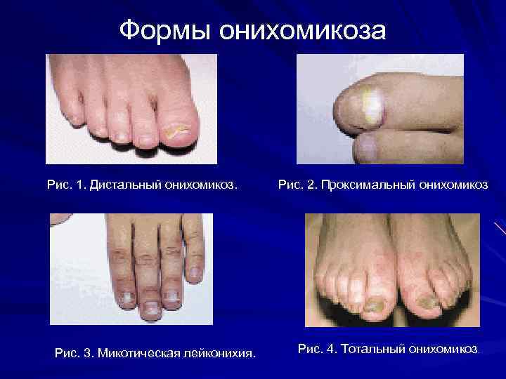 Формы онихомикоза Рис. 1. Дистальный онихомикоз. Рис. 3. Микотическая лейконихия. Рис. 2. Проксимальный онихомикоз